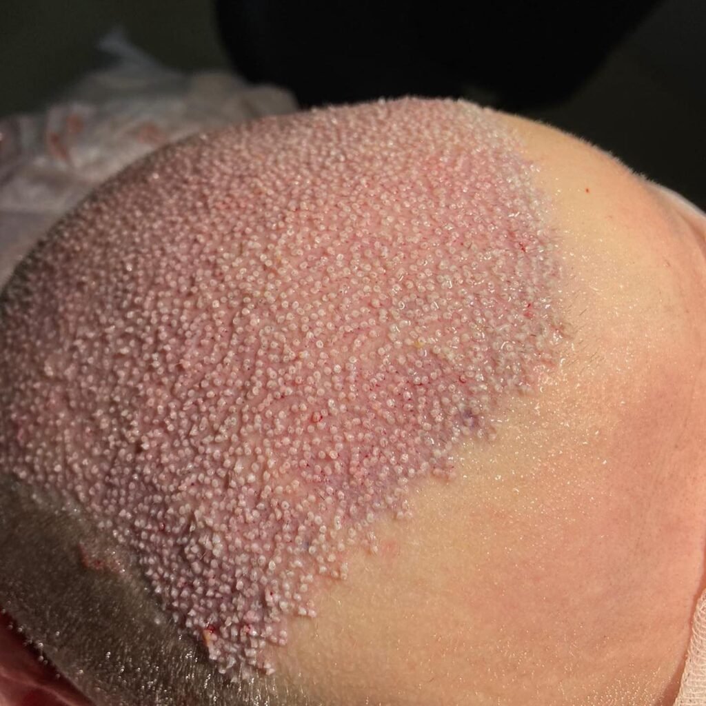Hair Transplant in Turkey