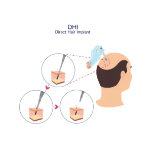 DHI Hair Transplant