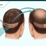 زراعة الشعر الهجينة في تركيا