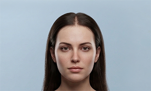 Receding hairline light