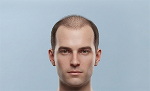 Receding hairline + slight crown