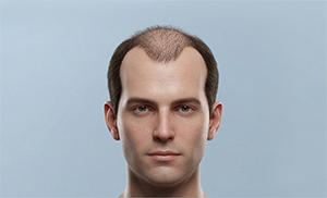 Receding hairline strong + crown