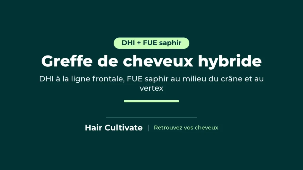 Greffe de cheveux hybride à Istanbul associant DHI et FUE saphir