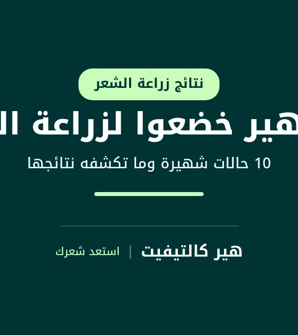 مشاهير خضعوا لزراعة الشعر