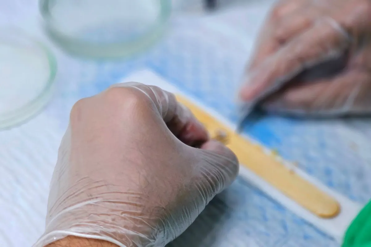 Gros plan de mains gantées triant des greffons lors d'une greffe de cheveux FUE manuelle