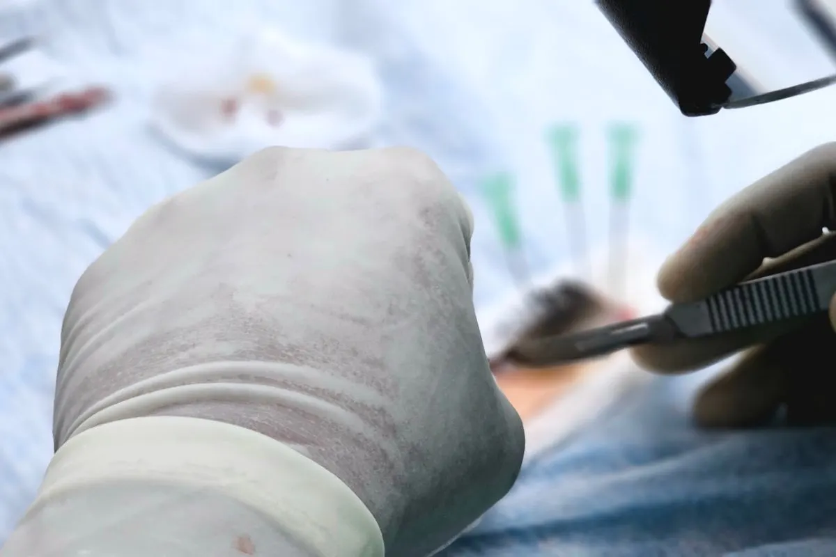 يد بقفاز طبي تضع البصيلات بملقط دقيق أثناء عملية زراعة الشعر بتقنية FUE السفير في تركيا