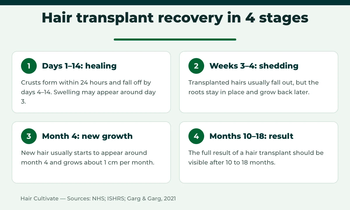 Hair transplant recovery timeline in four stages from day 1 to month 18